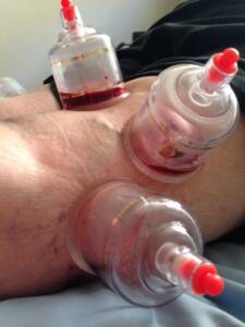 cupping-image1