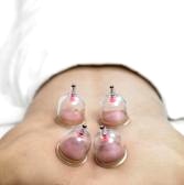 cupping-acupuncture